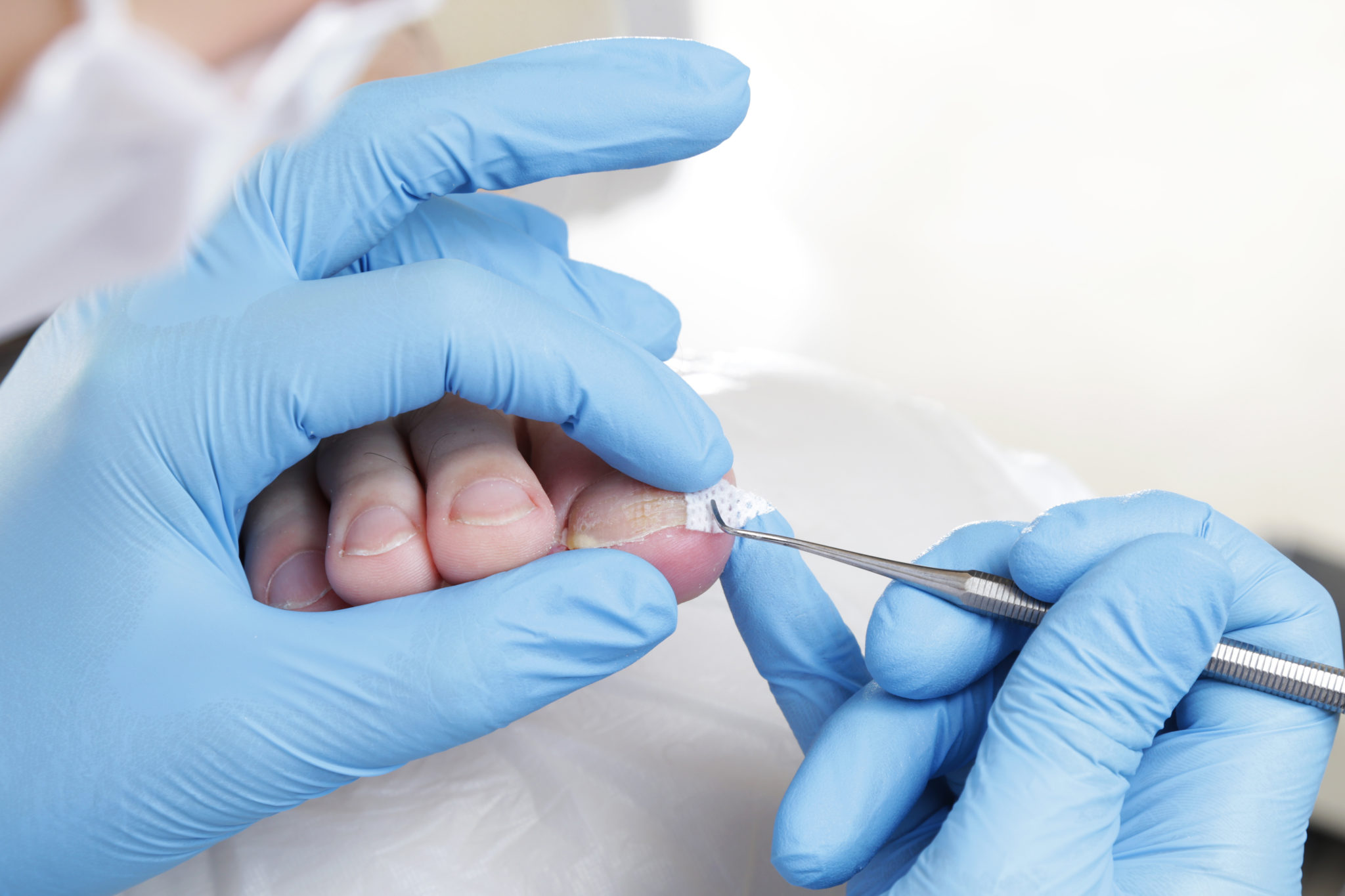 Korekta wrastających paznokci podologicznokosmetyczny Toruń