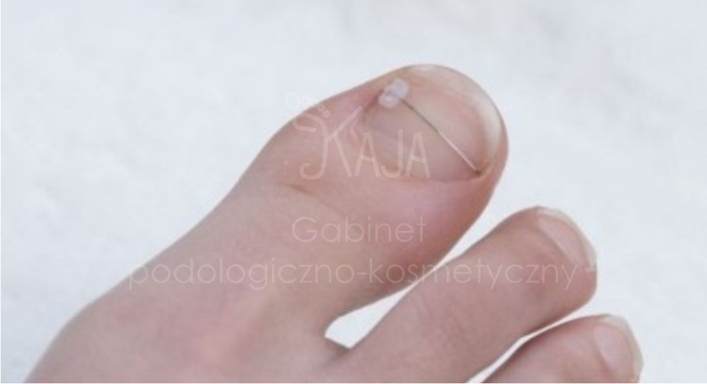 korekta wrastających paznokci – klamra drutowa jednostronna COMBIped